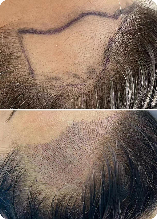 High-density hair transplant result AF method